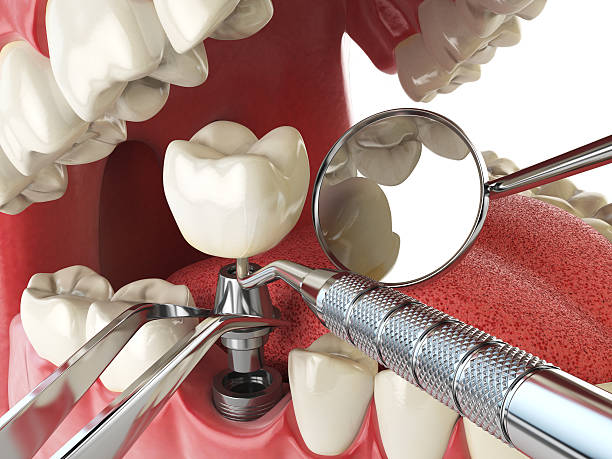 Best Emergency Treatment for Dental Infections or Abscesses in Belmont, VA